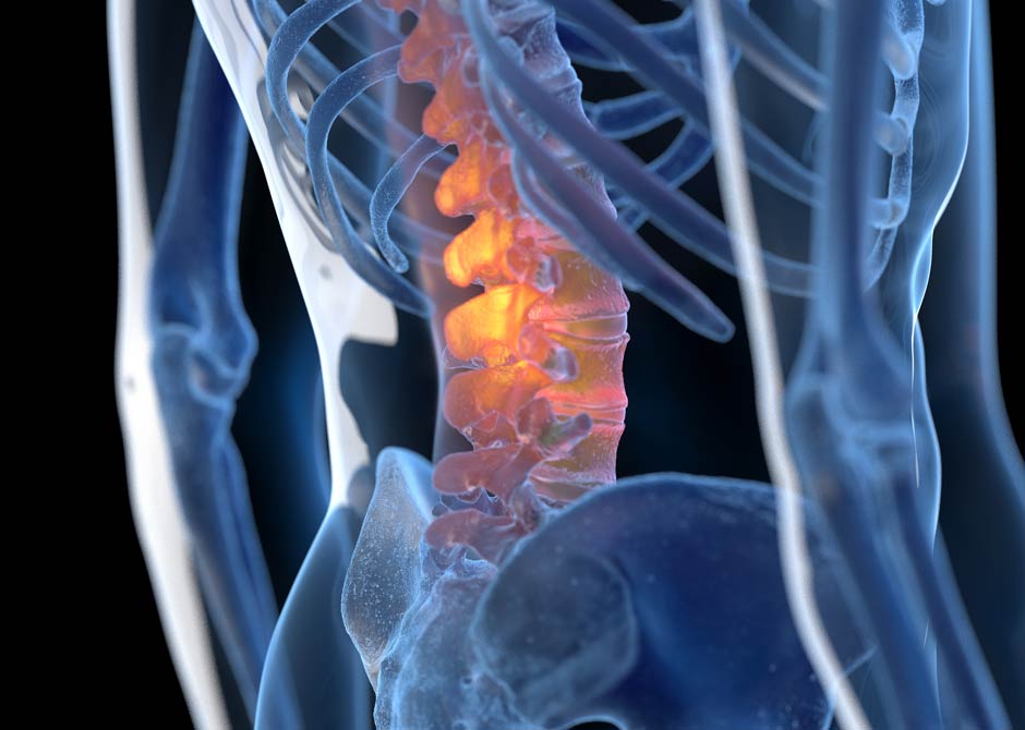 An illustration showing lumbar spine with chronic back pain